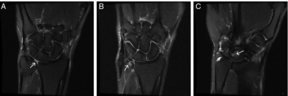 Figura 3 – A, Ressonância magnética evidencia lesão da fibrocartilagem triangular; B, Edema na cabec¸a da ulna; C, Edema no semilunar.