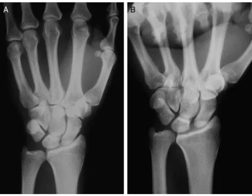 Figura 5 – Radiografia em pronac¸ão com preensão palmar (pronated grip views). 8 A, Sem pronac¸ão; B, Pronac¸ão com preensão palmar que altera a relac¸ão da ulna com o rádio.