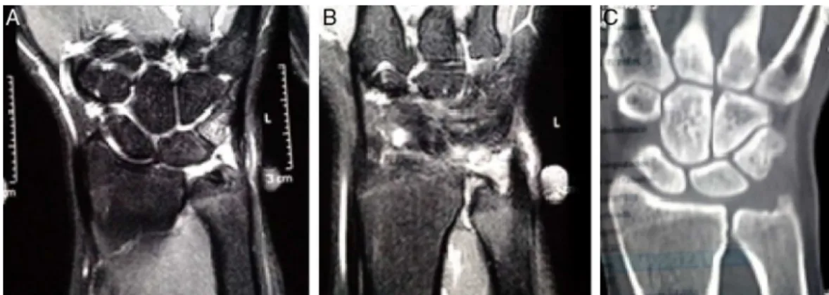 Fig. 1 – Images of case 1. (A) MRI evidencing synovitis and semilunar and pyramidal edema; (B) lesion of the triangular fibrocartilage in the distal portion only; and (C) tomography demonstrating neutral ulna.