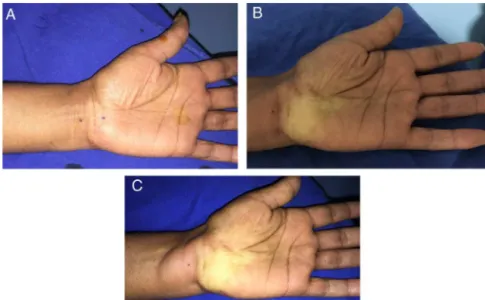 Fig. 4 – (A) Blockade with lidocaine and adrenaline proximal and distal to the wrist fold; (B) beginning of the vasoconstriction effect after 15 min; (C) complete effect after 30 min.