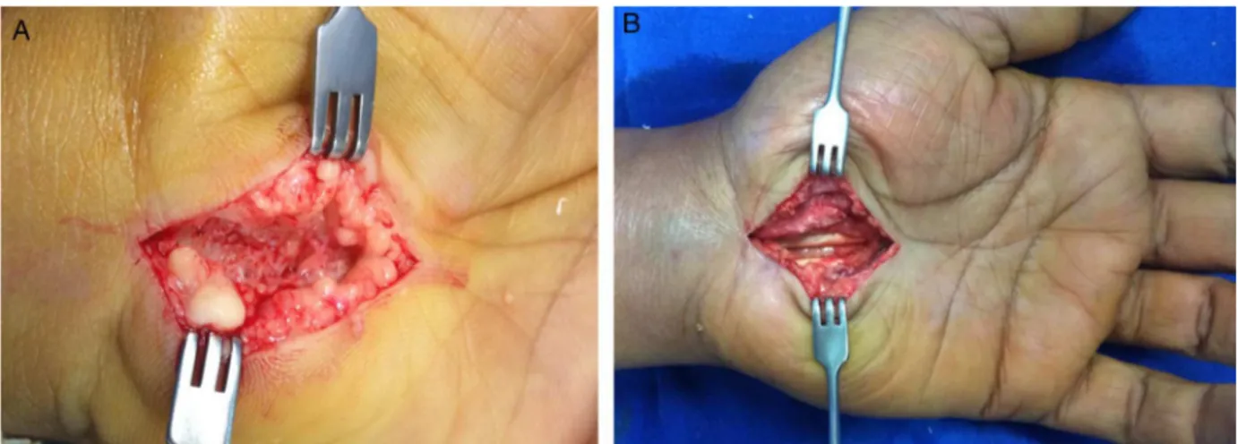 Fig. 5 – (A) Carpal tunnel release approach under lidocaine/adrenaline effect; (B) after the procedure and still under lidocaine/adrenaline effect, maintaining a bloodless operating field.