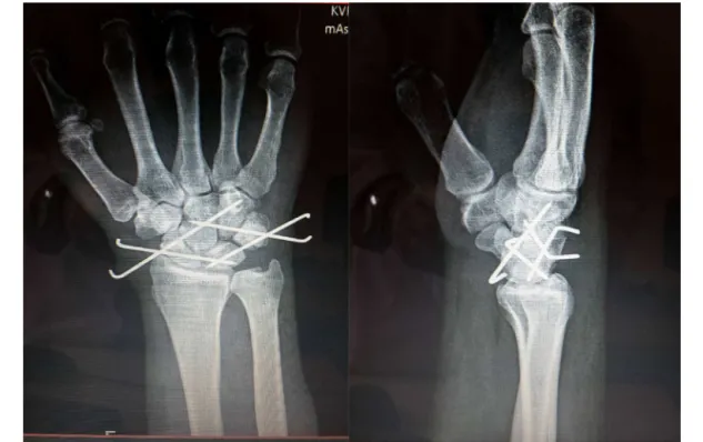 Fig. 7 – Radiograph of a case treated by closed reduction and percutaneous fixation.