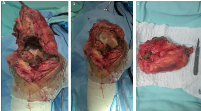 Figura 1 – Sinovite vilonodular pigmentada forma difusa do joelho – peroperatório de cirurgia aberta acesso anterior.