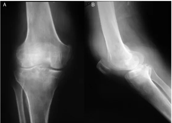 Fig. 2 – Knee radiograph of a diffuse pigmented villonodular synovitis of the knee in (A) antero-posterior and (B) profile, evidencing areas of bone destruction.
