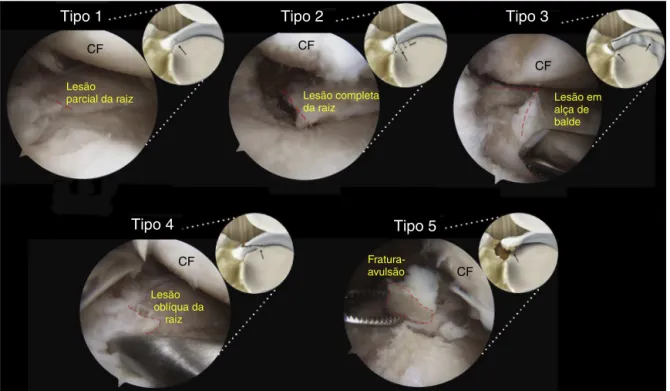 Figura 2 – Simulac¸ão artroscópica e ilustrac¸ão dos diferentes tipos de lesão de raiz meniscal classificados com base na morfologia: lesão de raiz parcial estável (tipo 1); lesão radial completa dentro de 9 mm em relac¸ão à fixac¸ão posterior no platô (ti