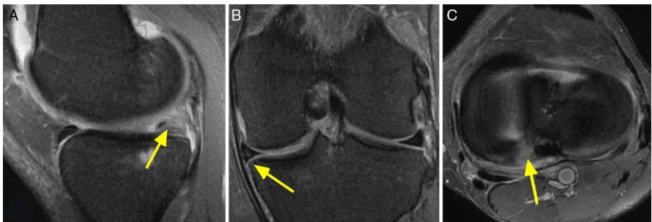 Figura 3 – Imagem de ressonância magnética ponderada em T2 de um joelho esquerdo com lesão da raiz posterior do menisco medial