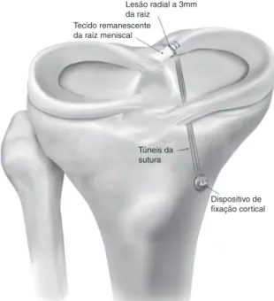 Figura 4 – Técnica para fixac¸ão de lesão da raiz meniscal posterior por meio de sutura transtibial fixada a um botão na face anteromedial da tíbia