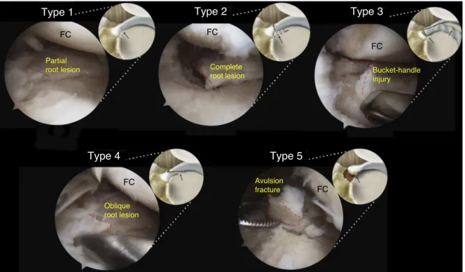 Fig. 2 – Arthroscopic simulation and illustration of the different types of meniscal root lesions classified based on