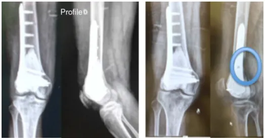 Fig. 5 – Patient 1 in the immediate post-operative period and in the relapse at 11 months.