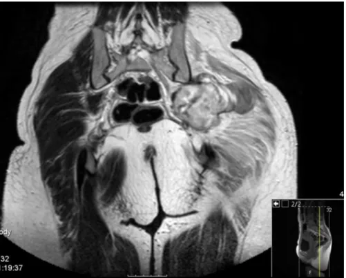 Figura 2 – Corte coronal de RMN da bacia ponderada em T2 que identifica a lesão na região glútea esquerda.