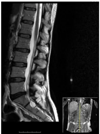 Fig. 1 – Sagittal section of a T2-weighted lumbar spine MRI disclosing of L5-S1 disk herniation.