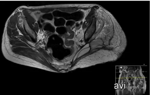 Fig. 4 – Axial section of a T2-weighted pelvic MRI in the postoperative period.