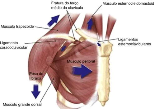 Figura 1 – Fratura desviada do terc¸o médio da clavícula.