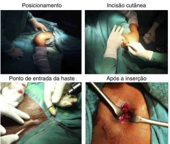 Figura 2 – Técnica cirúrgica (A) posicionamento; (B) incisão cutânea; (C) ponto de entrada da haste; (D) após a inserc¸ão.