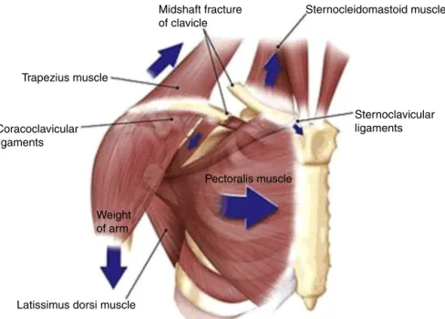 Fig. 1 – Displaced mid shaft clavicle fracture.