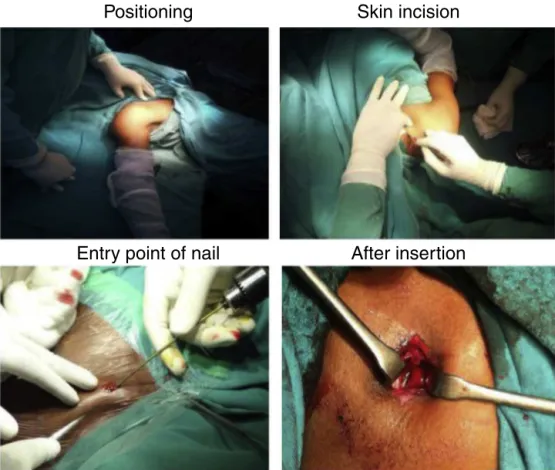 Fig. 2 – Surgical technique. (A) Positioning; (B) skin incision; (C) entry point of nail; (D) after insertion.