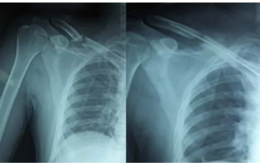 Fig. 3 – OTA type B fracture fixed with ESIN through Mini open technique. ESIN, elastic stable intramedullary nailing.