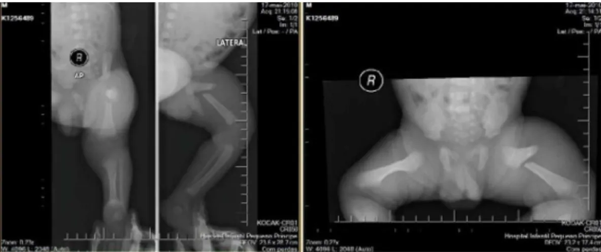 Figura 5 – Fratura de fêmur em crianc¸a de um mês de idade.