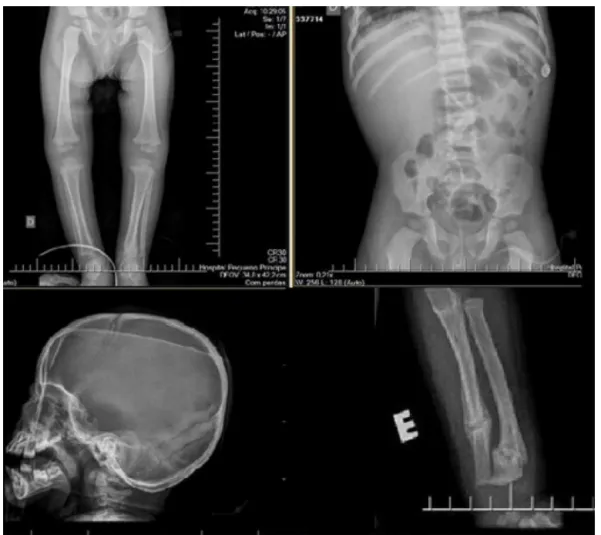 Figura 6 – Sinais clássicos de MTCAA, fraturas em diferentes estágios de consolidac¸ão em crianc¸a de 15 meses.