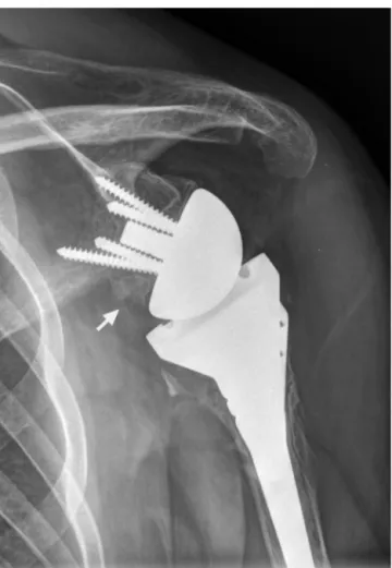 Figura 1 – Radiografia pós-operatória. Artroplastia reversa do ombro com notching escapular.