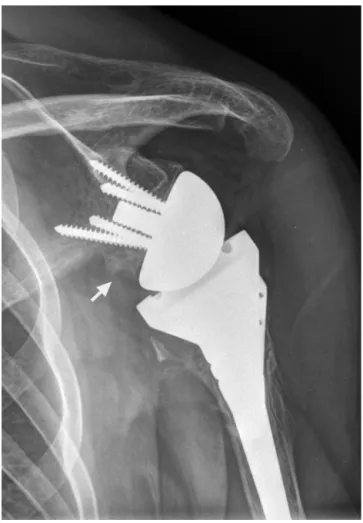 Fig. 1 – Post-operative radiograph. Reverse shoulder arthroplasty with scapular notching.