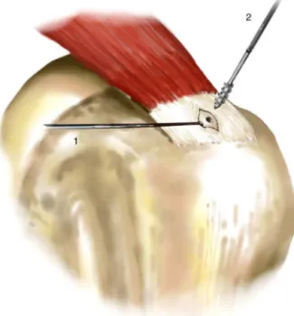 Figura 3 – (1) Afastador colocado posteriormente na reborda posterior da abertura no tendão para melhorar a visão em profundidade; (2) Posic¸ão de introduc¸ão da âncora em direc¸ão ao orifício anterior no leito ósseo.