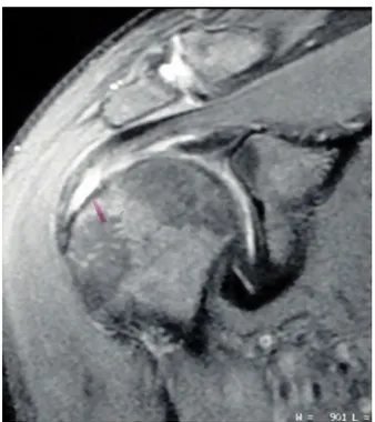 Figura 7 – Corte coronal de RM ponderada em T2 do ombro direito pré-operatória mostra lesão de espessura parcial articular do supraespinal de alto grau.