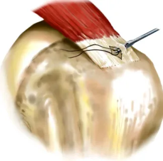 Fig. 4 – Each tip of the anchor wire is transported to the tendon via wire passer at different points.