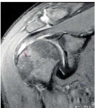 Fig. 7 – Preoperative T2-weighted MRI coronal cut of right shoulder shows partial-thickness SS lesion of high grade.