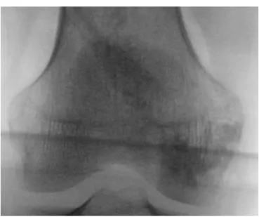 Fig. 3 – Image of intraoperative radioscopy, with radiopacity after filling by subchondroplasty, in a region mapped using magnetic resonance imaging.