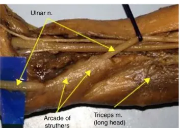 Fig. 2 – Stillborn arm dissected as a pilot, showing the ulnar nerve surrounded by the medial head of the triceps.