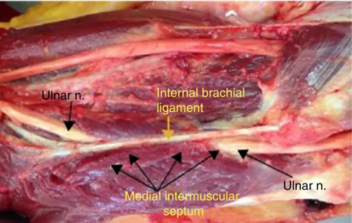 Fig. 8 – In one limb, the presence of epitrochlear anconeus muscle was observed. Medial epicondyle (a)