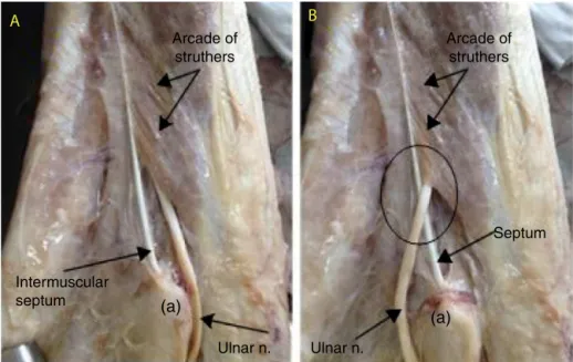 Fig. 10 – The arcade of Struthers may be responsible for recurrence of compressive neuropathy of the ulnar nerve after anterior transposition of the nerve at the elbow