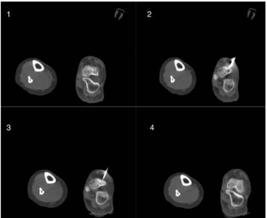 Fig. 1 – (1) Axial CT scan of the left foot, indicating osteolytic lesion with sclerotic halo, located in the domus of the talus, compatible with osteoid osteoma; (2) introduction of the Jamshidi needle through the nidus; (3) positioning of the ablation ne