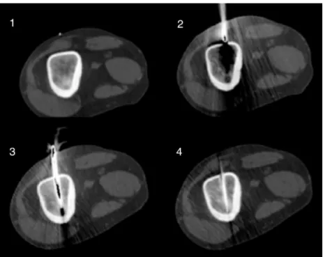 Fig. 3 – (1) Axial CT scan of the right arm showing an osteolytic lesion with sclerotic halo, located in the humerus, associated with cortical thickening, suggestive of osteoid osteoma; (2) beginning of insertion of the Jamshidi needle; (3) Jamshidi needle