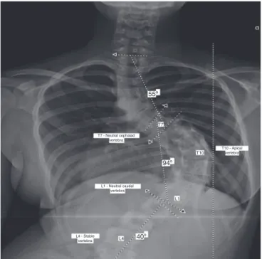 Table 3 – Neutral cephalad vertebra.