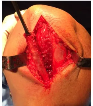 Fig. 1 – Intraoperative image showing the repair of the ruptured tendon.