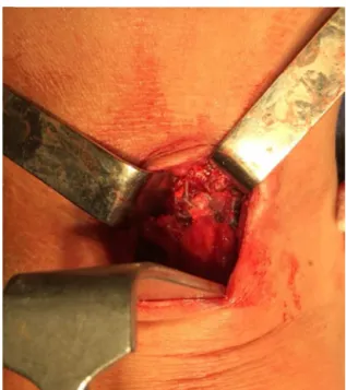 Fig. 5 – Intraoperative image showing the fixation of the graft to the ruptured biceps tendon.