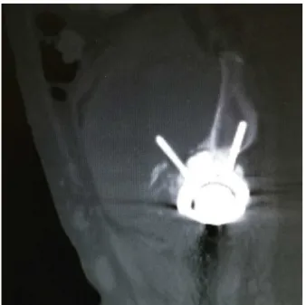 Figura 3 – Parafuso acetabular intrapélvico.