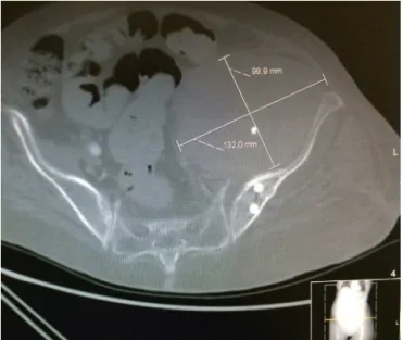 Fig. 1 – CT scan showing intrapelvic hemotoma.