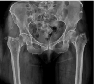 Fig. 2 – Postoperative anteroposterior radiograph after bilateral cemented arthroplasty.