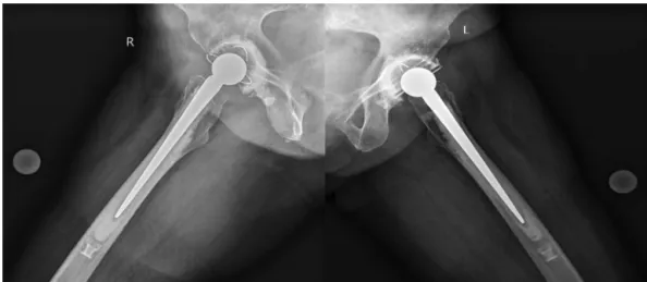 Fig. 3 – Postoperative lateral radiograph after bilateral cemented arthroplasty.