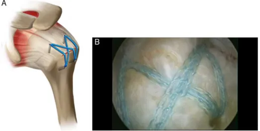 Fig. 1 – Transosseous equivalent suture technique (suture bridge). (A) Drawing showing the rotator cuff repair; (B) intraoperative image of the shoulder after the repair.