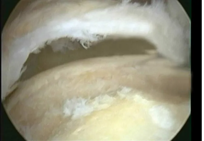 Fig. 3 – Intraoperative image of the shoulder showing an extensive rotator cuff lesion.