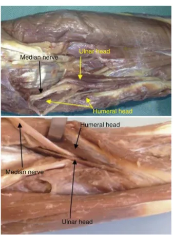 Fig. 1 – In 86 limbs, the humeral and ulnar heads of the PR muscle were well individualized.