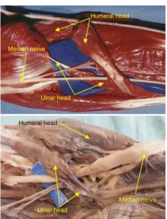 Fig. 5 – Absence of the ulnar head of the PTM. In this situation, the median nerve passed through the humeral head in three limbs.