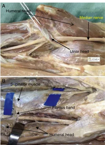 Fig. 7 – (A) In four limbs, the ulnar head of the PTM was represented by a fibrous band not associated with a muscle component; (B) in two limbs, a fibrous expansion extended from the supinator muscle to the humeral head of the PTM, passing as a band over 