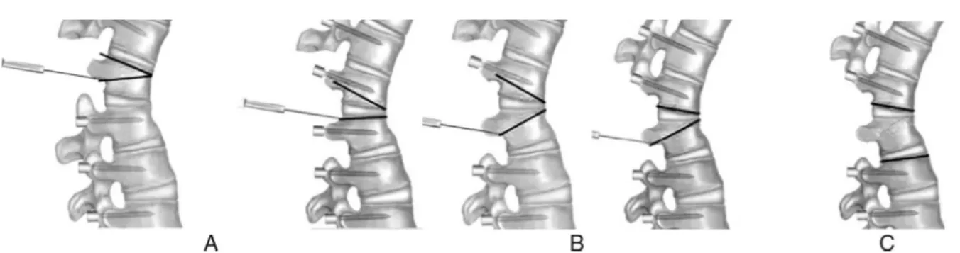 Fig. 1 – Types of three-column osteotomy. (A) Pedicular subtraction osteotomy (PSO); resection of a vertebral body wedge.
