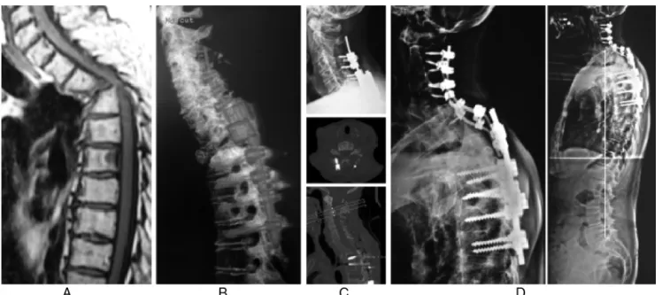 Fig. 4 – Angular kyphosis due to pathological fracture of T3 after multiple myeloma treatment