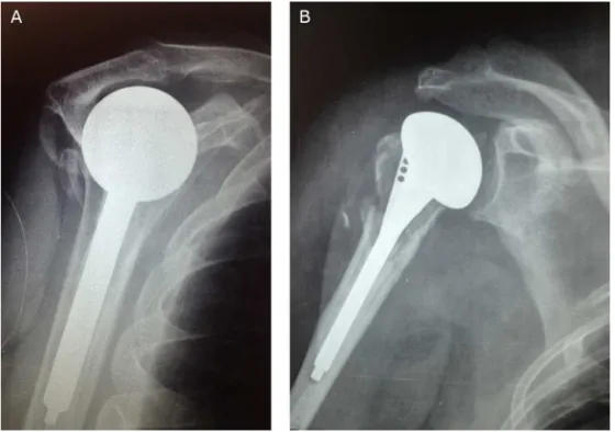 Fig. 4 – Radiograph in true anteroposterior and Neer profile for postoperative control of shoulder arthroplasty with local humeral head graft.